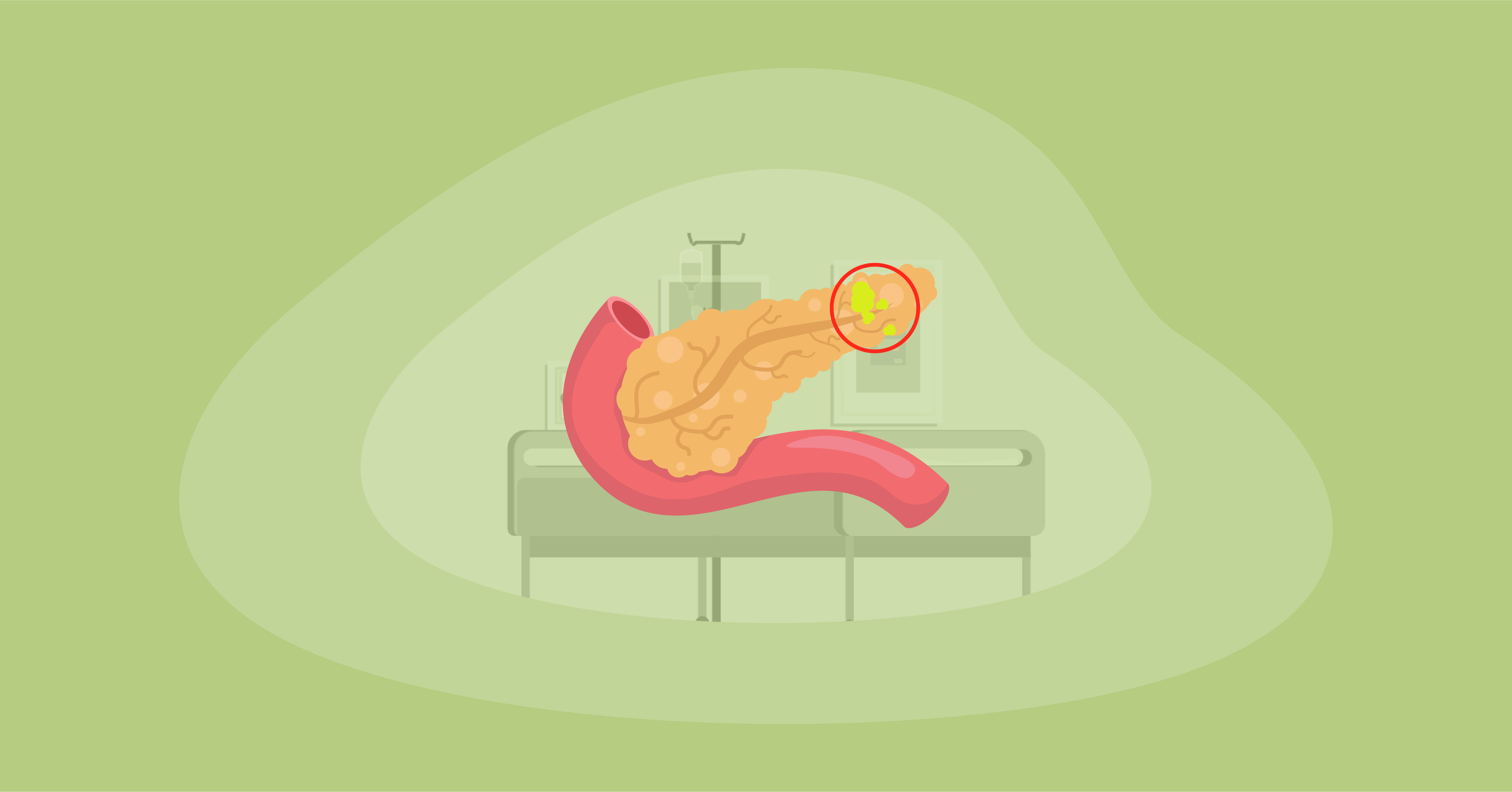 Attempted illustration of pancreatic cancer