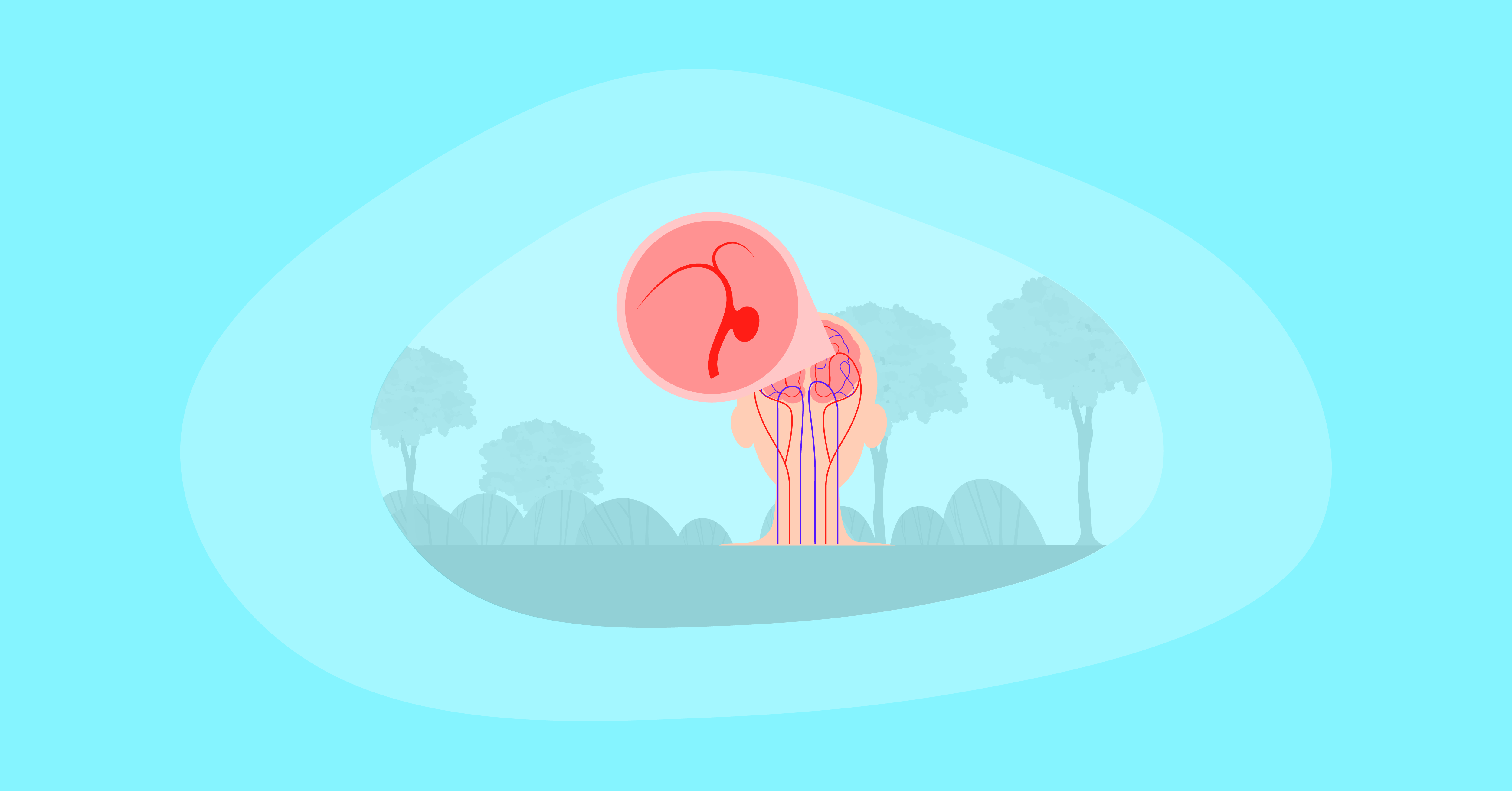 Illustration of brain aneurysm